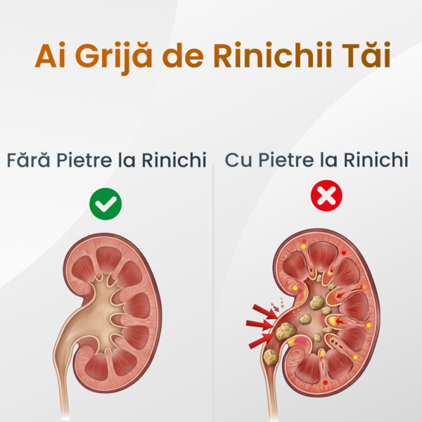 rinichi-sanatosi-vs-rinichi-cu-pietre